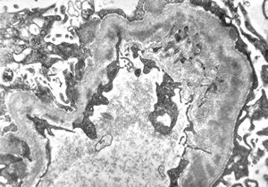 M,53y. | type III membranoproliferative glomerulonephritis M,53y. | type III membranoproliferative glomerulonephritis